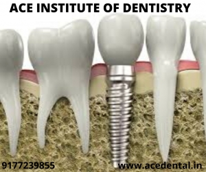 Dental Implantology Courses in India By Experts